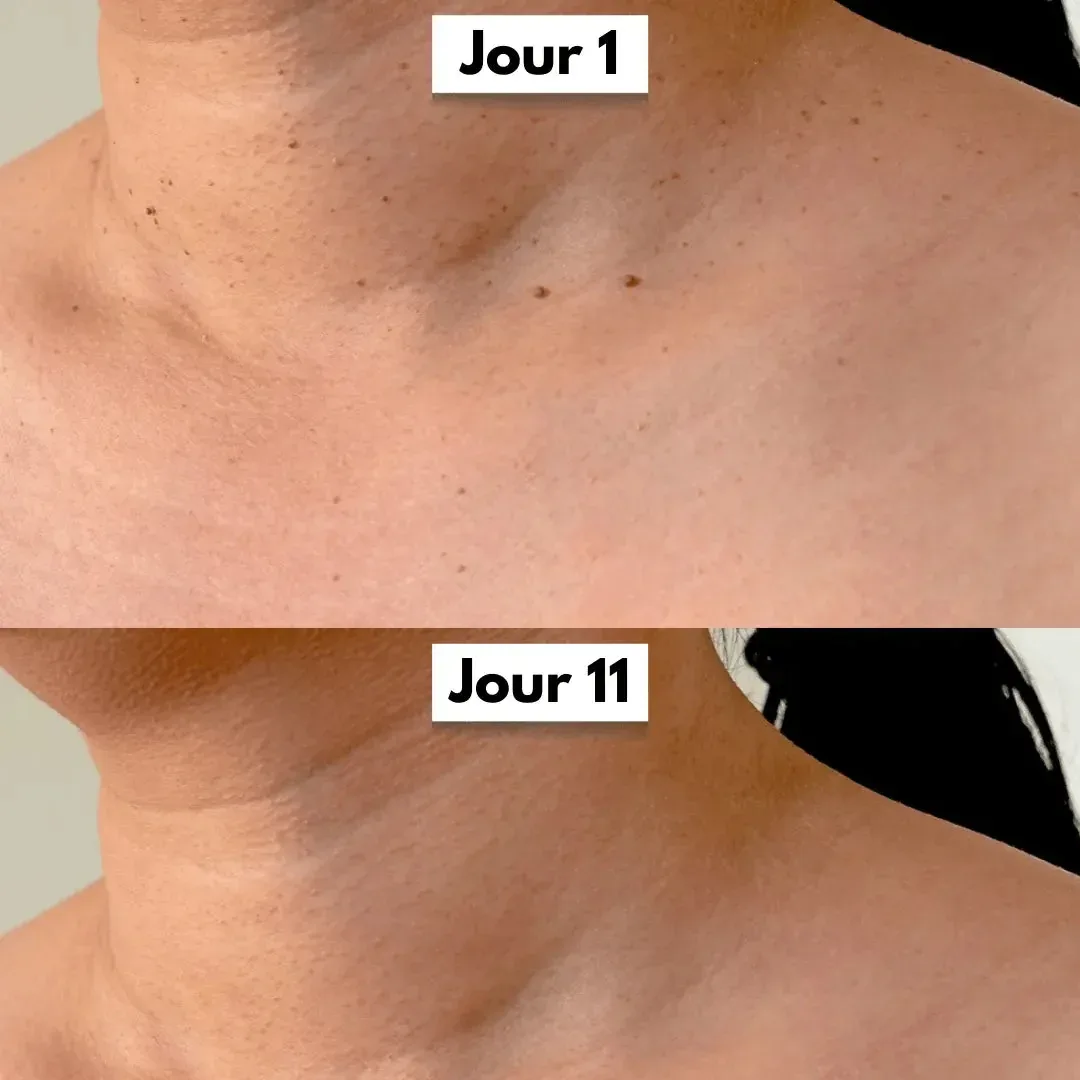 DermaCore | Anti-Excroissances de Peau