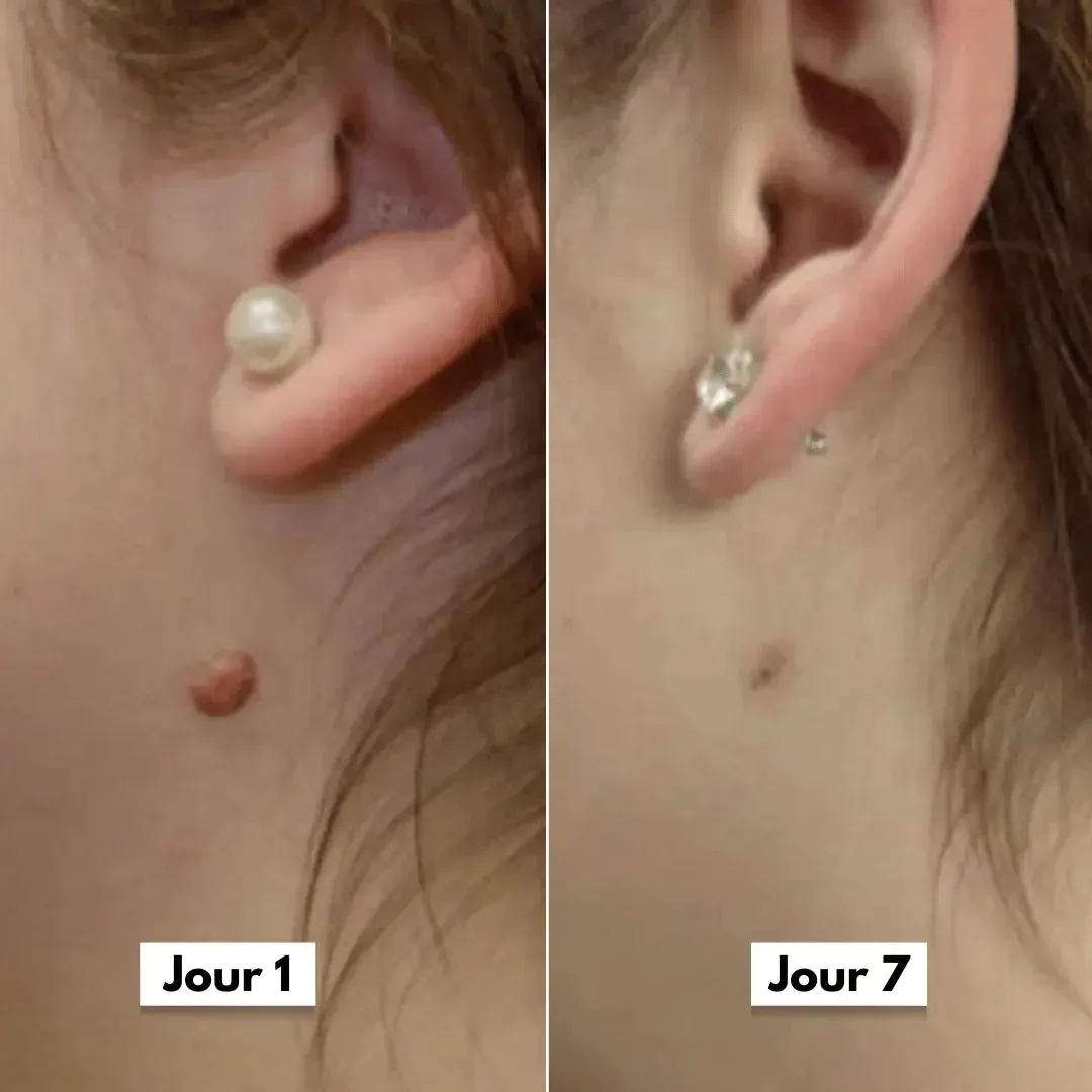 DermaCore | Anti-Excroissances de Peau