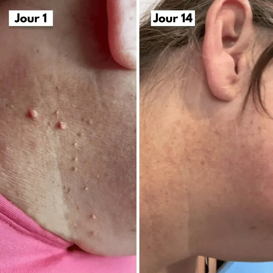 DermaCore | Anti-Excroissances de Peau